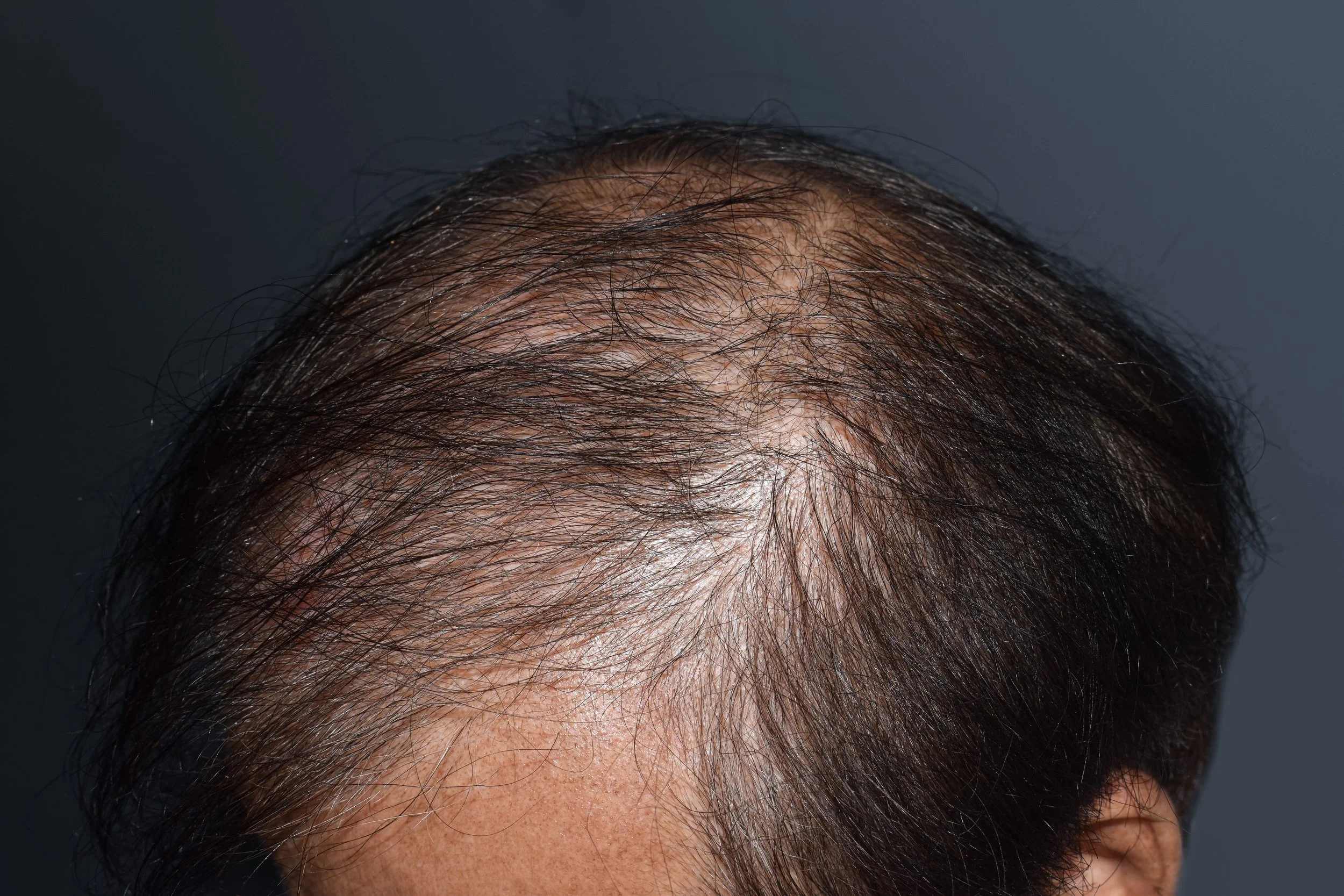 Baldness treatment